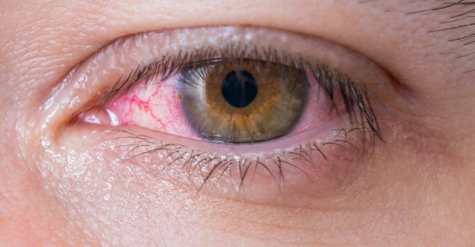 26-science-backed-remedies-to-get-rid-of-red-eyes-well-being-secrets